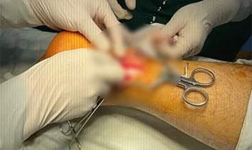 Đắk Nông: Phẫu thuật thành công đứt hoàn toàn gân gót chân