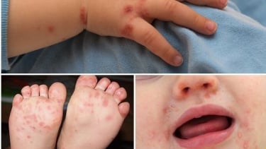 Vắc xin EV71 – Hy vọng mới trong phòng, chống bệnh tay chân miệng tại Việt Nam
