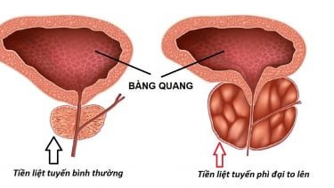 Bệnh phì đại tuyến tiền liệt: Có nên quan hệ tình dục?