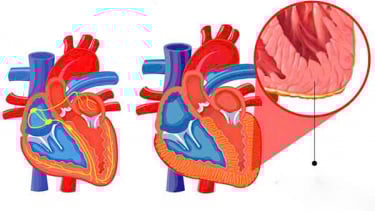 Viêm cơ tim: Bệnh lý nguy hiểm dễ nhầm lẫn