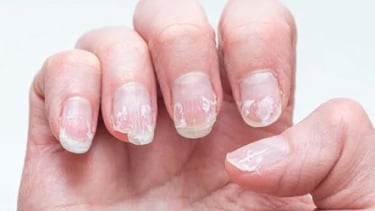 Bổ sung vitamin và khoáng chất nào khi móng tay giòn, dễ gãy?