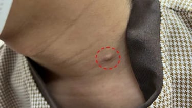 Mụn lâu lành biến thành ung thư da