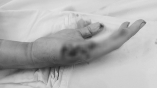 Bệnh viện Quân Y 175 cứu thành thông bàn tay bị đứt lìa 2 ngón cho nam bệnh nhân