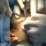 TP.HCM: Căng chỉ da mặt tại spa, 2 bệnh nhân bị áp xe nặng