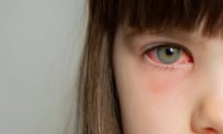 Những dấu hiệu đau mắt đỏ bạn không thể bỏ qua
