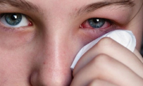 Một số mẹo chữa đau mắt đỏ nhanh nhất, hiệu quả nhất 