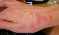 Bệnh ghẻ: Nguyên nhân, triệu chứng, chẩn đoán và cách điều trị