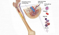 Tổng quan về bệnh suy tuỷ xương: Nguyên nhân, triệu chứng và cách điều trị