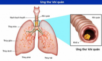 Những điều cần biết về ung thư khí quản: Nguyên nhân, chẩn đoán và cách điều trị 