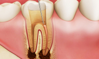 Bệnh viêm tủy răng: Dấu hiệu, biến chứng, cách điều trị và phòng ngừa