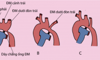 Kiến thức Y học về bệnh hẹp eo động mạch chủ