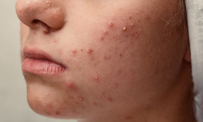 Thông tin Y khoa: Mụn trứng cá (Tên Tiếng Anh: Acne)