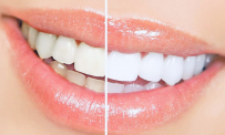 Thông tin Y khoa: Tẩy trắng răng (Tên Tiếng Anh: Bleaching, dental)