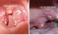 Thông tin y khoa: Ung thư vòm họng (tên tiếng Anh: Pharyngeal cancer)