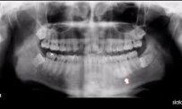 Thông tin Y khoa: Sự vôi hoá răng (Tên Tiếng Anh: Calcification, dental)