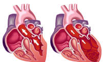 Thông tin Y khoa: Bệnh cơ tim (Tên Tiếng Anh: Cardiomyopathy)