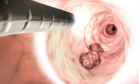 Thông tin Y khoa: Soi kết tràng (Tên Tiếng Anh: Colonoscopy)