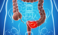 Thông tin Y khoa: Ung thư kết tràng (Tên Tiếng Anh: Colon, cancer of)