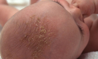 Thông tin Y khoa: Vảy đầu (Tên Tiếng Anh: Cradle cap)