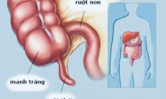 Thông tin Y khoa: Viêm ruột thừa (Tên Tiếng Anh: Appendicitis)