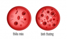 Những điều cần biết về bệnh thiếu máu do thiếu sắt ở trẻ em