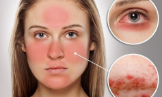 Biểu hiện của bệnh lupus ban đỏ hệ thống và cách điều trị