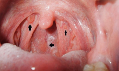 Thông tin Y khoa: Sùi vòm họng, VA (Tên Tiếng Anh: Adenoid)