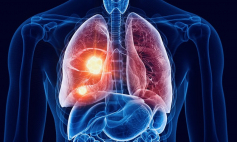 Thông tin Y khoa: Bệnh bụi than phổi (Tên Tiếng Anh: Anthracosis)