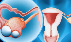 Thông tin Y khoa: U nguyên bào buồng trứng nam hóa (Tên Tiếng Anh: Arrhenoblastoma)