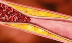 Thông tin Y khoa: Xơ vữa động mạch (Tên Tiếng Anh: Atherosclerosis)