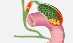 Thông tin Y khoa: Tắc ống mật (Tên Tiếng Anh: Bile duct obstruction)