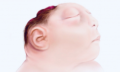 Thông tin Y khoa: Quái thai không não (Tên Tiếng Anh: Anencephaly)