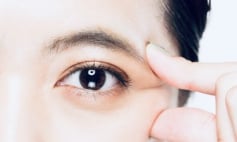 Thông tin Y khoa: Phẫu thuật tạo hình mi mắt (Tên Tiếng Anh: Blepharoplasty)