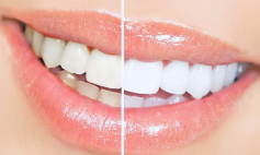 Thông tin Y khoa: Tẩy trắng răng (Tên Tiếng Anh: Bleaching, dental)