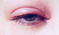 Thông tin Y khoa: Viêm mi mắt (Tên Tiếng Anh: Blepharitis)