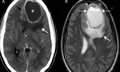 Thông tin Y khoa: Áp xe não (Tên Tiếng Anh: Brain abscess)