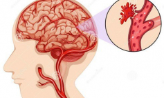 Thông tin Y khoa: Xuất huyết não (Tên Tiếng Anh: Brain haemorrhage)