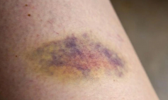 Thông tin Y khoa: Vết thâm tím (Tên Tiếng Anh: Bruise)