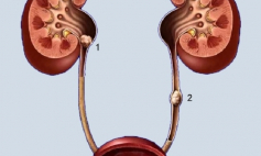 Thông tin Y khoa: Sỏi đường tiểu (Tên Tiếng Anh: Calculus, urinary tract)