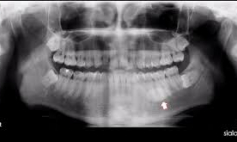 Thông tin Y khoa: Sự vôi hoá răng (Tên Tiếng Anh: Calcification, dental)