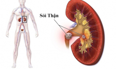 Thông tin Y khoa: Sỏi (Tên Tiếng Anh: Calculus)