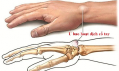 Thông tin Y khoa: Viêm nang, viêm bao (Tên Tiếng Anh: Capsulitis)