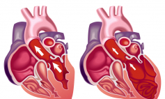 Thông tin Y khoa: Bệnh cơ tim (Tên Tiếng Anh: Cardiomyopathy)