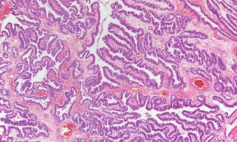 Thông tin Y khoa: Carcinoma (Tên Tiếng Anh: Carcinoma)