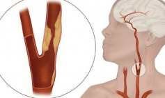 Thông tin Y khoa: Động mạch cảnh (Tên Tiếng Anh: Carotid artery)