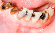 Thông tin Y khoa: Sâu răng (Tên Tiếng Anh: Caries, dental)