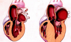 Thông tin Y khoa: Tim to (Tên Tiếng Anh: Cardiomegaly)