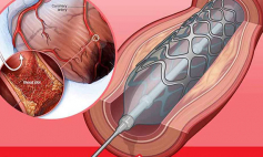 Thông tin Y khoa: Thông tim (Tên Tiếng Anh: Catheterization, cardiac)