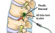 Thông tin Y khoa: Phong bế đuôi ngựa (Tên Tiếng Anh: Caudal block)