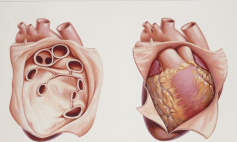 Thông tin Y khoa: Viêm màng trong tim (Tên Tiếng Anh: Endocarditis)